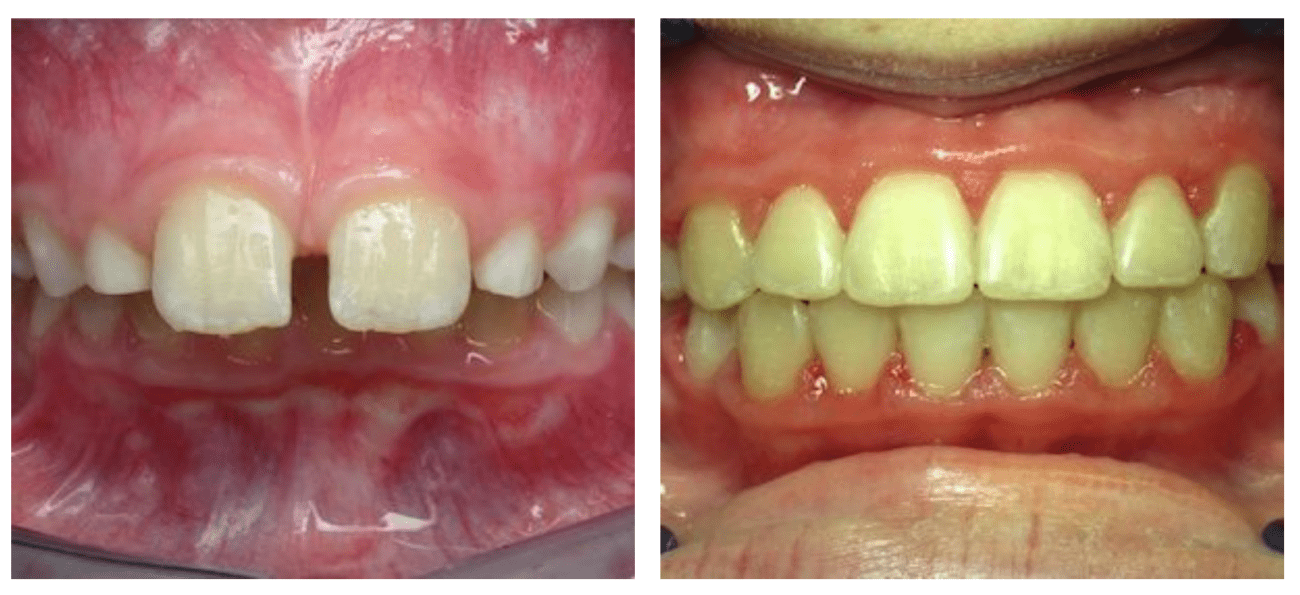 Correction of severe overbite and gummy smile in patients with